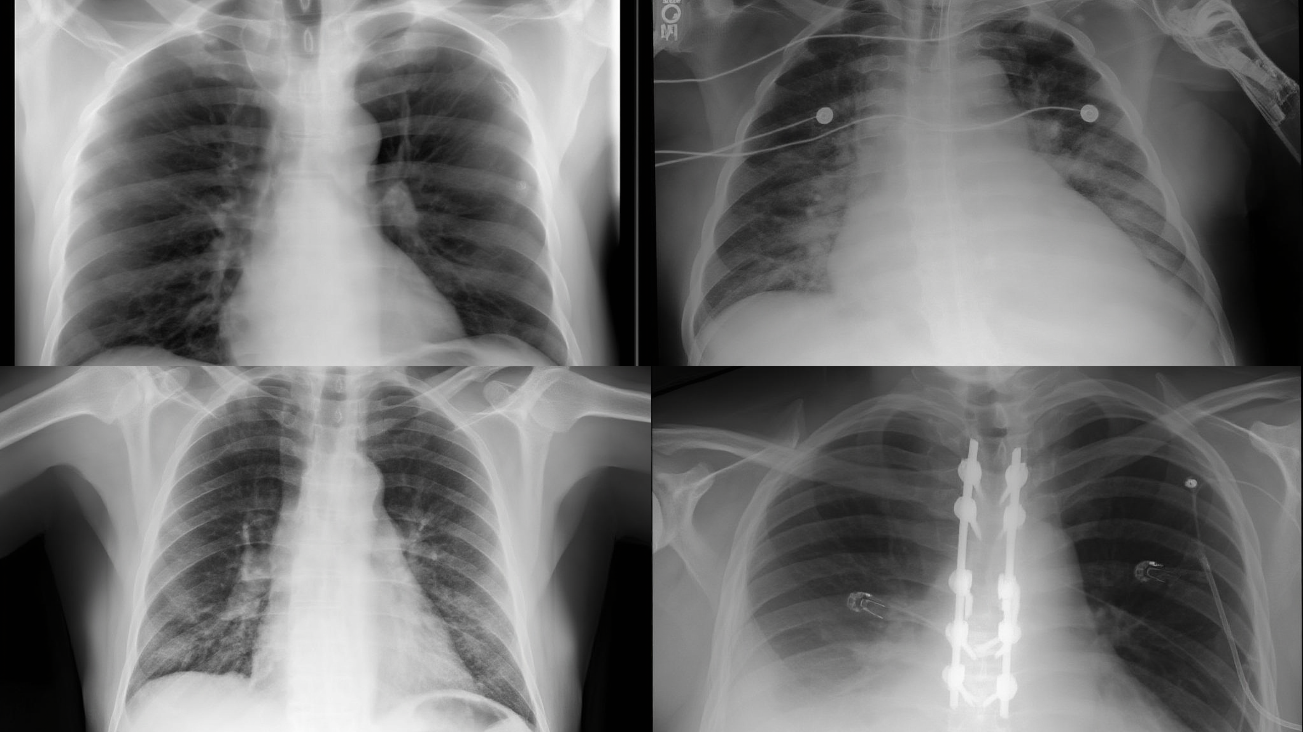 Chest X-Ray