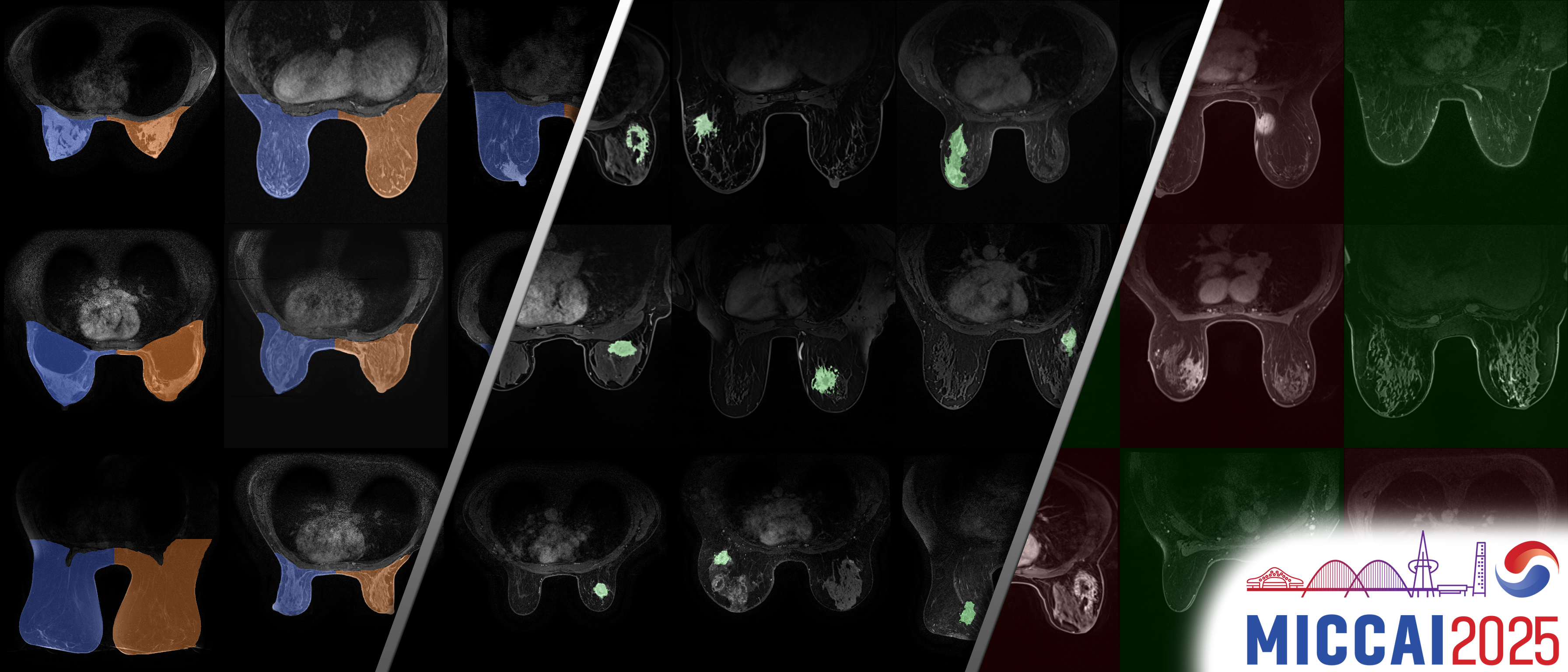 BreastDivider Overview